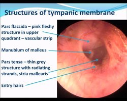 Otitis Externa - Recent advances in the treatment of ears